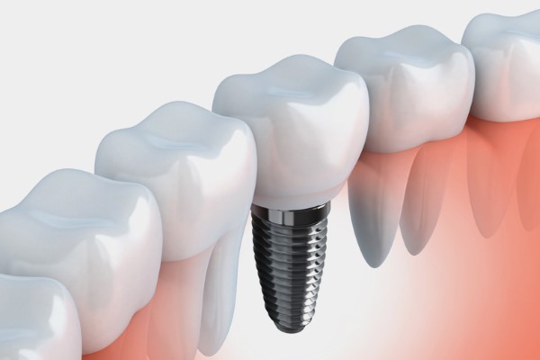 Dental-implants-Jaipur
